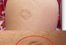 Imate ožiljak na nadlaktici? Evo šta on zapravo znači – i zašto ga imaju svi rođeni u bivšoj Jugoslaviji!